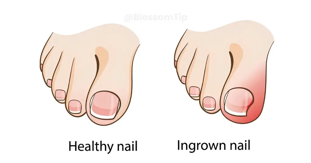 The Ultimate Guide to Ingrown Toenail Relief [2024 updated]