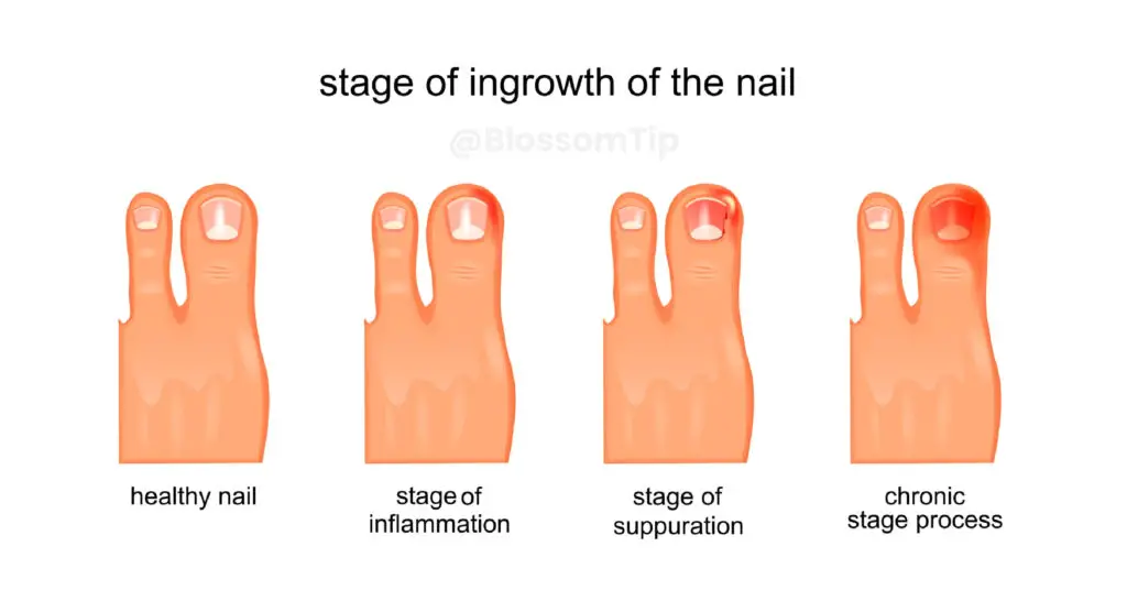 Ingrown toenail